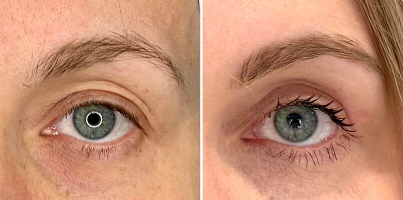 Before and after photo: Brow lift