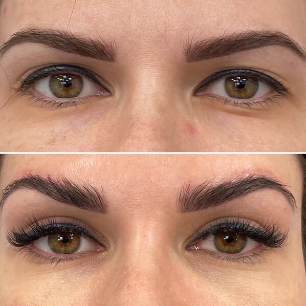 Before and after photo: Brow lift