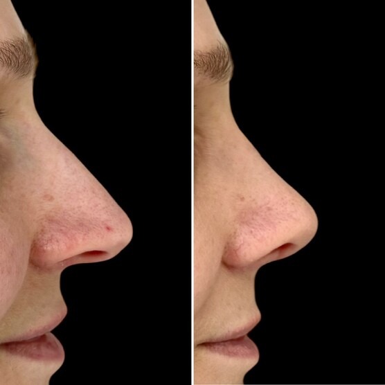 Before and after photo: Rhinoplasty