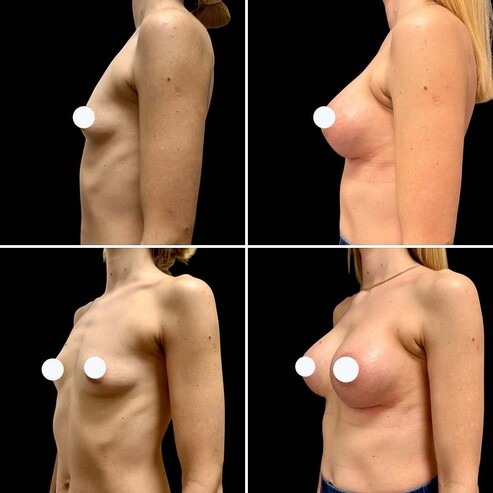 Before and after photo: Breast augmentation with implants
