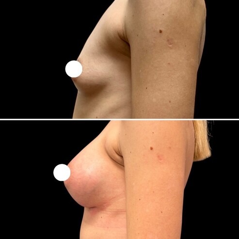 Before and after photo: Breast augmentation with implants