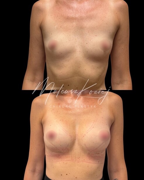 Before and after photo: Breast augmentation with implants