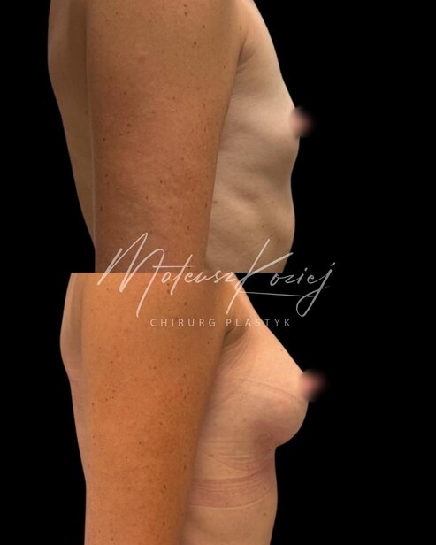 Before and after photo: Breast augmentation with implants